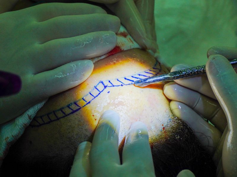 diferença entre transplante e implante capilar resultados