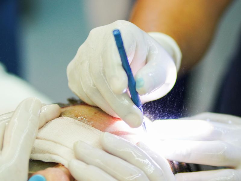 Entenda a diferença entre transplante e implante capilar