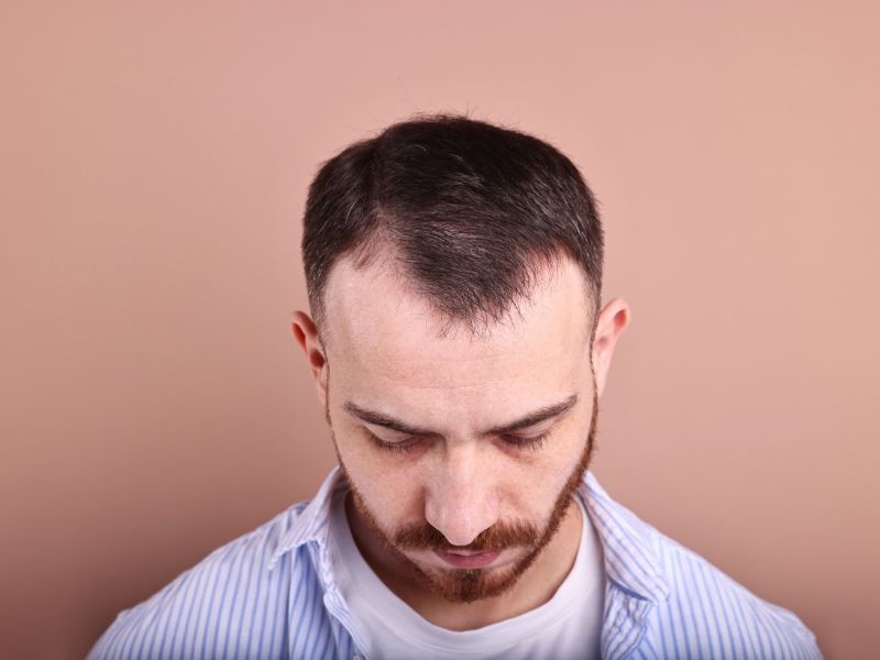 qual melhor remédio para calvície opções