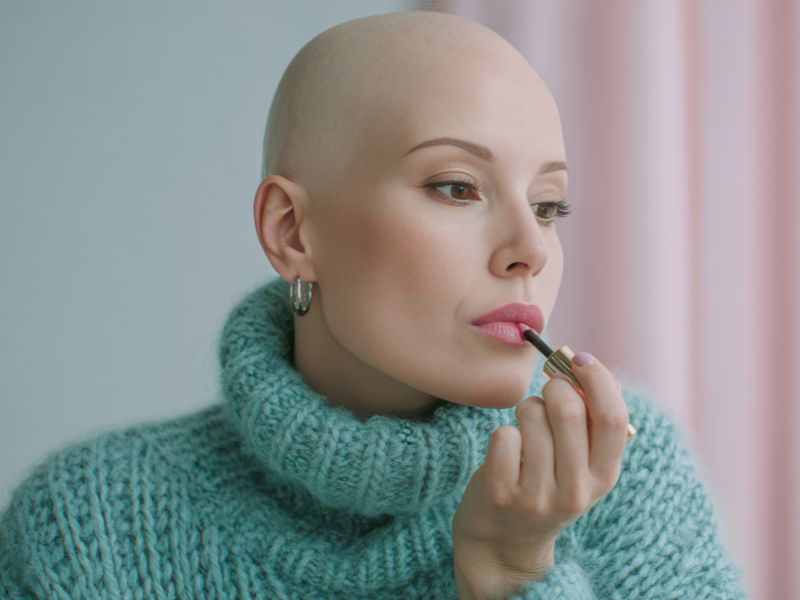 tipos de calvície alopécia