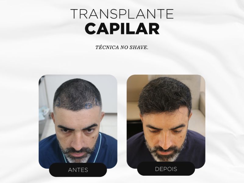 Resultados de antes e depois do transplante capilar