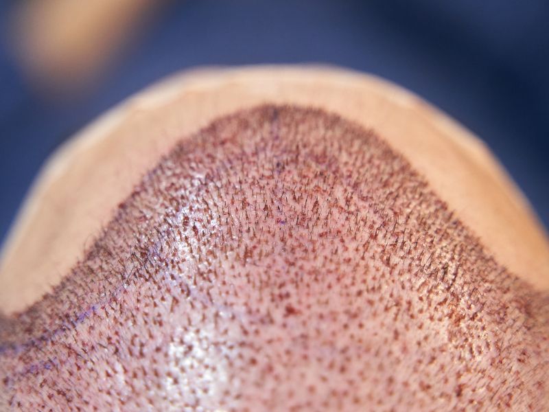 10 dias após transplante capilar FUE: o que esperar?