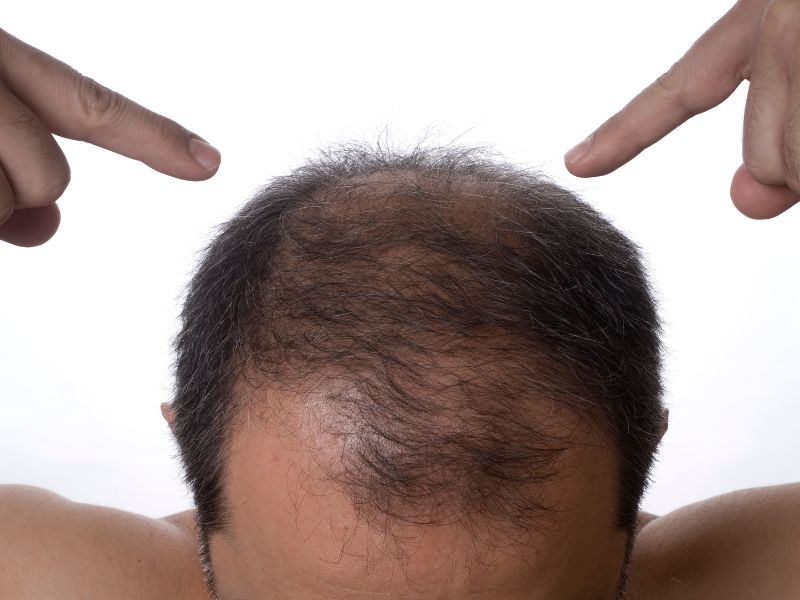 calvície masculina abordagens