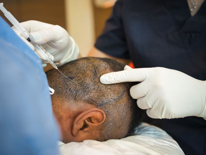 implante capilar recife preço benefícios