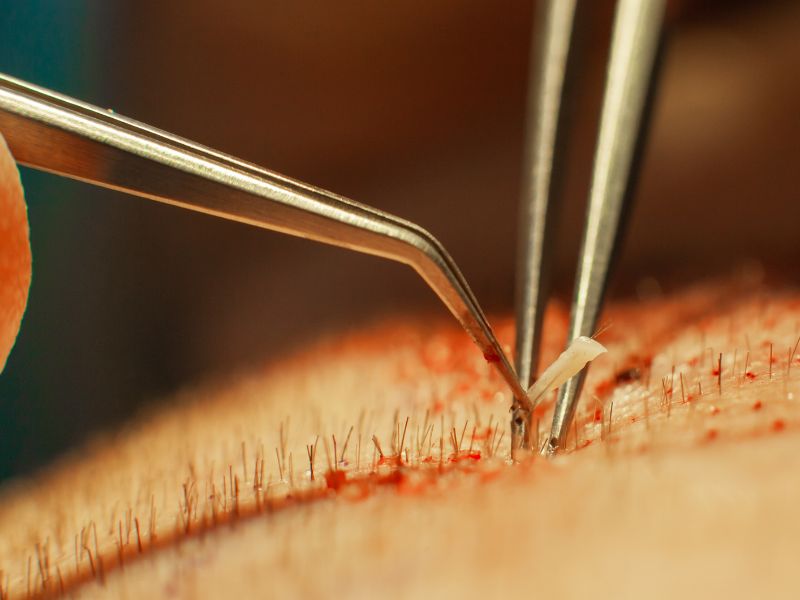 transplante capilar dura quanto tempo resultados