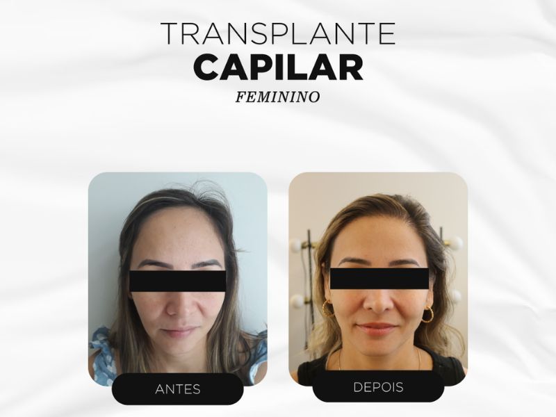 transplante capilar fue antes e depois etapas