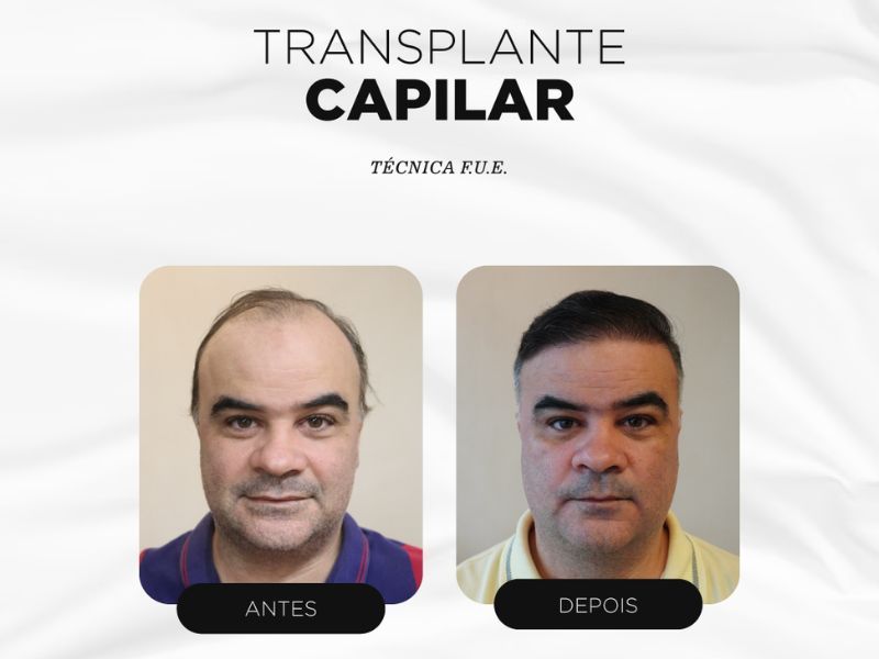 Resultados de antes e depois do transplante capilar FUE