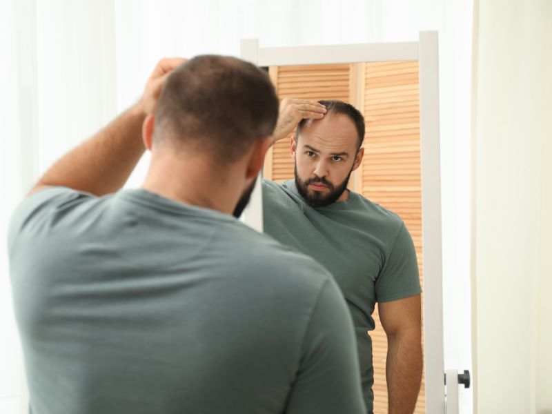 Graus de calvície: classificação e como identificar