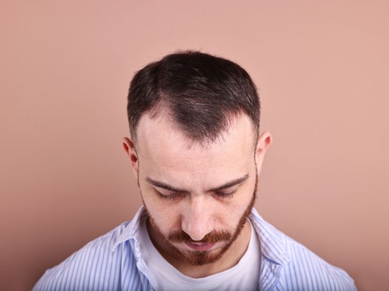 Calvície tipo M: causas, identificação e tratamentos