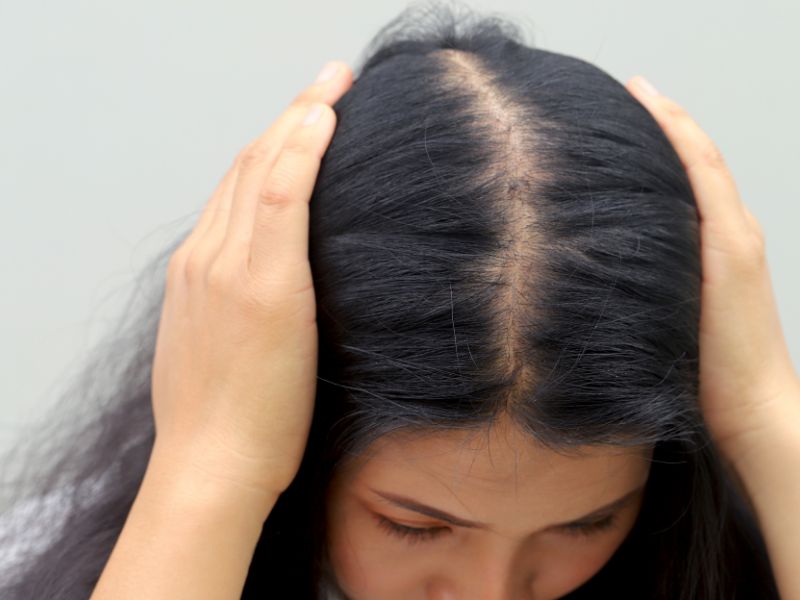 O que é alopecia: causas, tipos e tratamentos para a queda