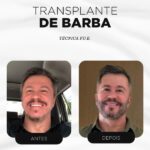 transplante capilar barba antes e depois