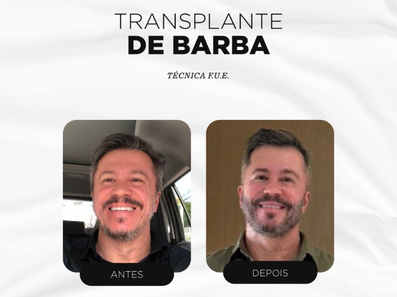 Resultados: antes e depois de transplante capilar na barba