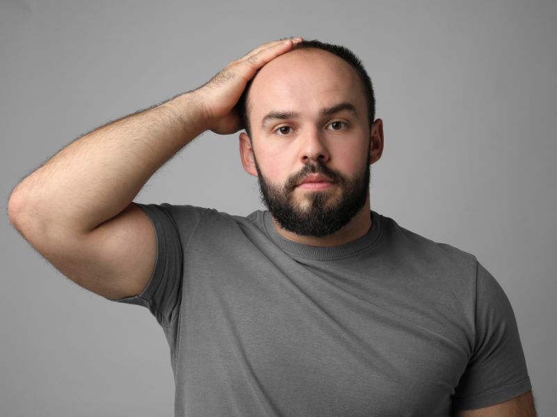 Calvície grau 3: características e opções de tratamento