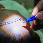 cirurgia de implante capilar