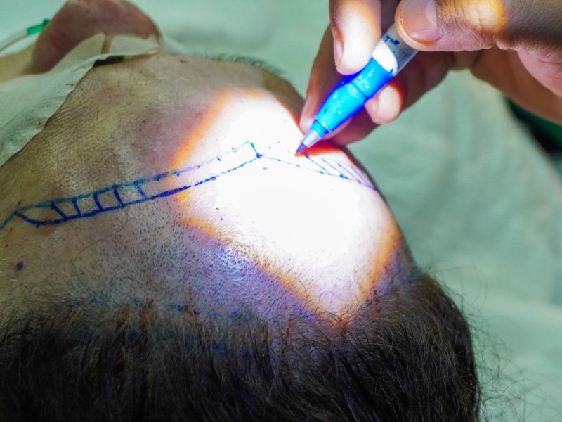 cirurgia de implante capilar procedimento