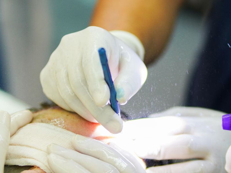 cirurgia de implante capilar processo