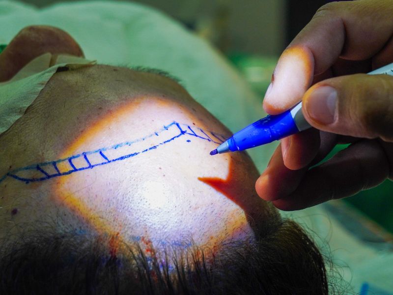 Cirurgia de implante capilar com resultado 100% natural