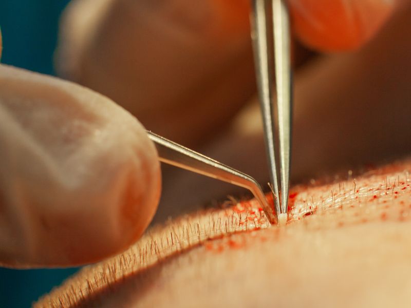 como dormir após implante capilar termo