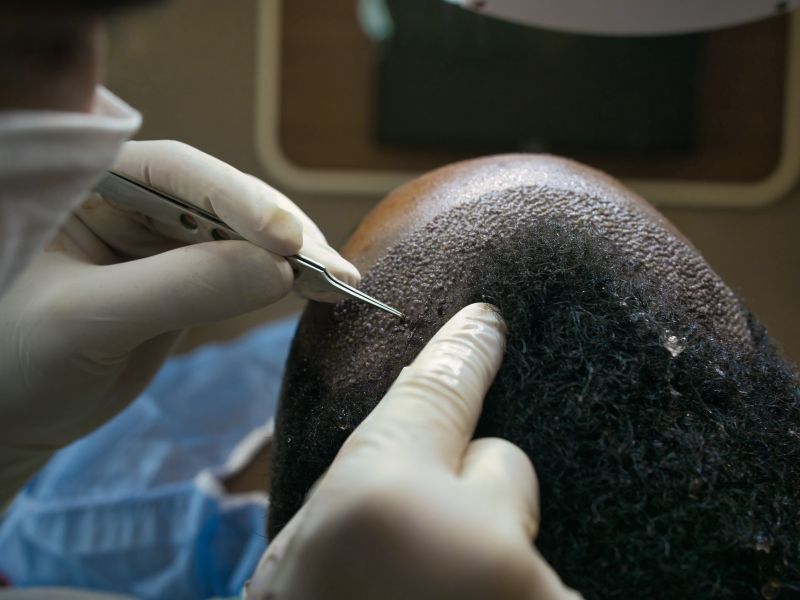 quem faz implante capilar vantagens