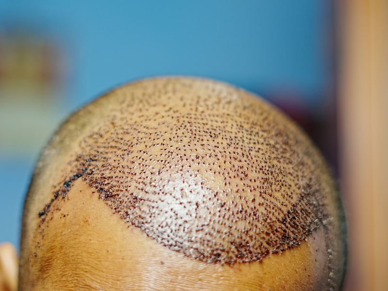 quanto tempo depois do transplante capilar pode usar boné proteção