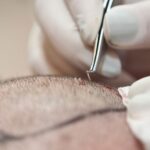 transplante capilar grau 7 antes e depois