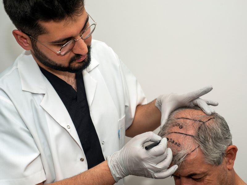 transplante capilar grau 7 antes e depois alopecia