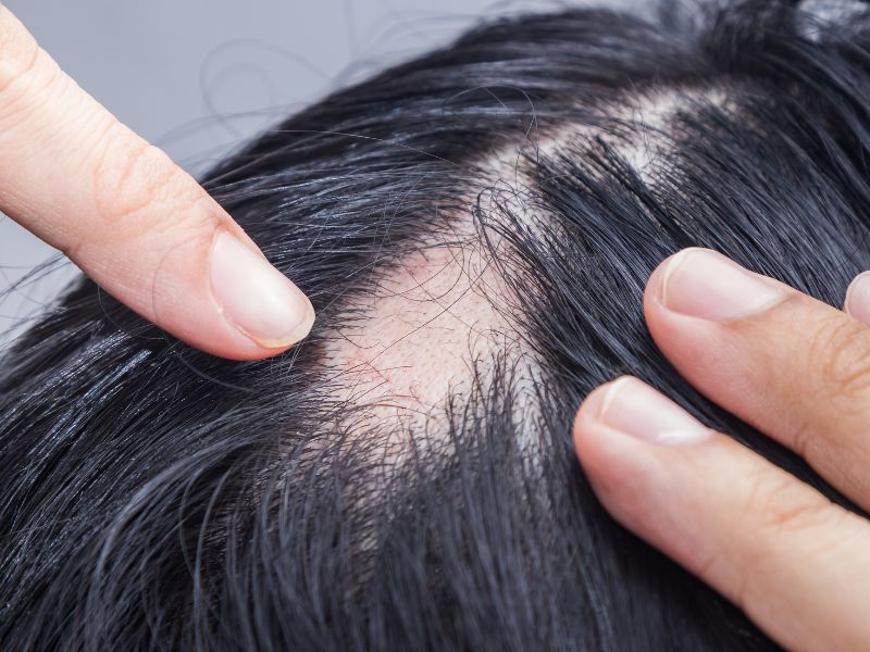quem tem alopecia pode fazer transplante capilar procedimento