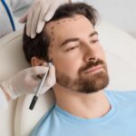 transplante capilar para diminuir a testa