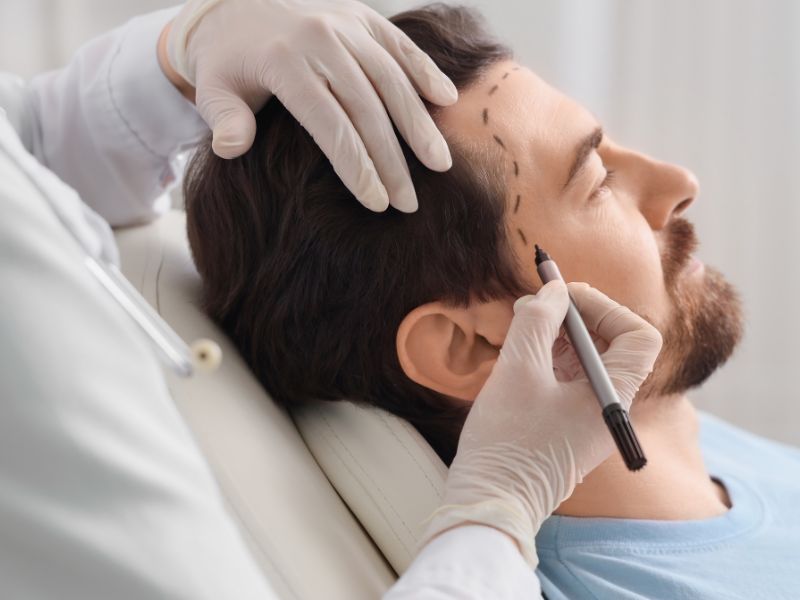 transplante capilar para diminuir a testa procedimento