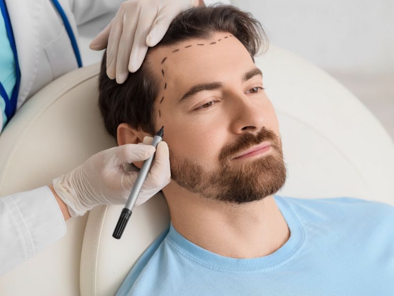 Transplante capilar para diminuir a testa: como funciona?