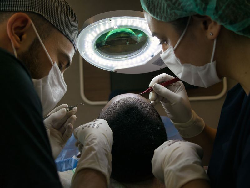 transplante capilar recuperação processo