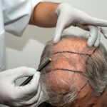 tipos de transplante capilar